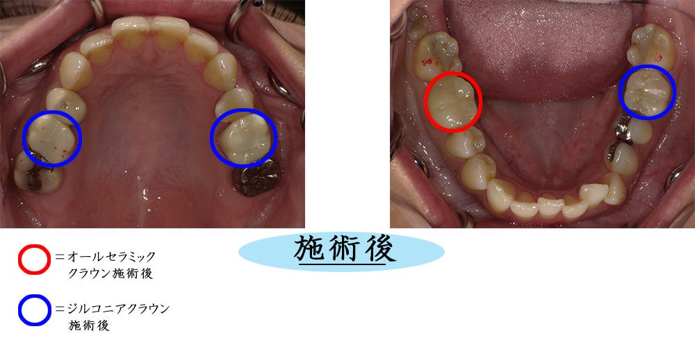 オールセラミッククラウンとジルコニアクラウンba22