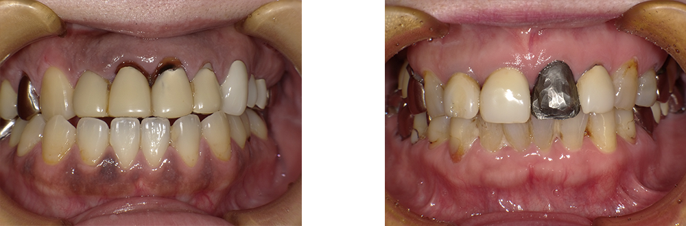 前歯のかぶせ物の劣化やはがれた症例