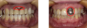 前歯のかぶせ物の劣化やはがれた症例1